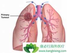 ��������(Cometriq)����MET��ROS1ͻ��ķΰ�����Ч����ô����