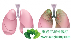 ΪʲôPD-1���Ƽ����ƺ��Сϸ���ΰ�ת��ΪСϸ���ΰ��ˣ�