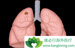 ��������(Lorlatinib)����ROS1���Ի���Ч��������ô����