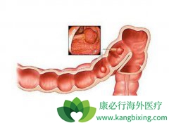 ��������������Irinotecan�������ӻ�ת����ֱ���᳦���Ľ�չ