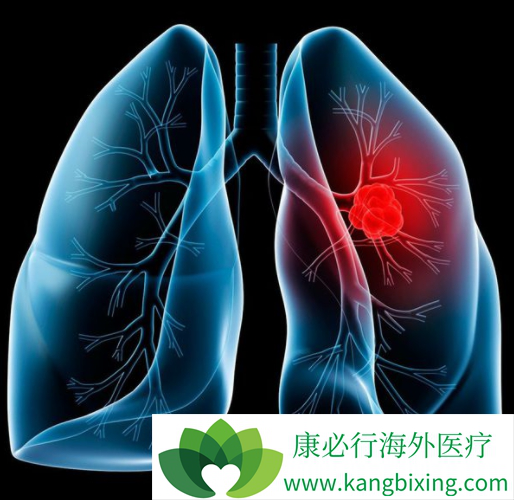 晚期肺癌 晚期肺癌