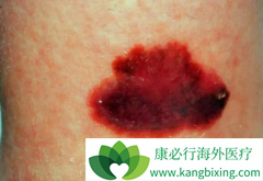 ��ķ�������ƺ�ɫ����Ч��Զ��Ipilimumab��