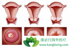 HPV���������ƹ�������HPV�������Ч����ʱ���Ƕ�ã�