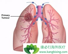 ����ת���Էΰ��Ĳ����ٴ�֢״���ֵķ���