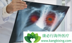 ��������(crizotinib)�����ڼ仼��Ҫ������ת��