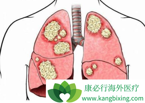 肺癌脑转移 肺癌脑转移