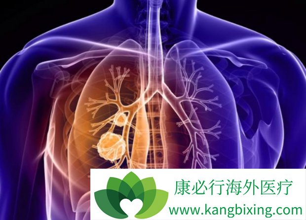 非小细胞肺癌 非小细胞肺癌