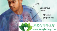��Ƥ�����������忪���˷�Сϸ���ΰ�NSCLC���ߵİ�������ʱ��