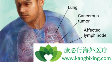 NSCLC