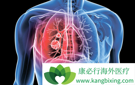 肺癌放疗 肺癌放疗