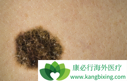 黑色素癌 黑色素癌