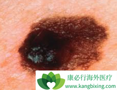 ���緢�ֺ�ɫ������֢״����ߺ�ɫ��������Ч���Ĺؼ�