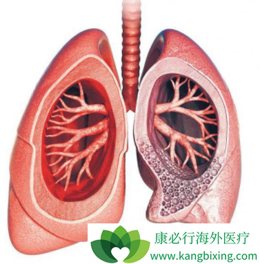 特发性肺纤维化 特发性肺纤维化