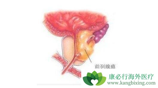 前列腺癌 前列腺癌