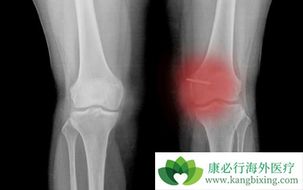 纤维肉瘤 纤维肉瘤