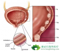 ����FGFR3ͻ����·��Ƥ������ҩvofatamab���FDA����ͨ���ʸ�