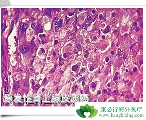 肾上腺皮质癌 肾上腺皮质癌