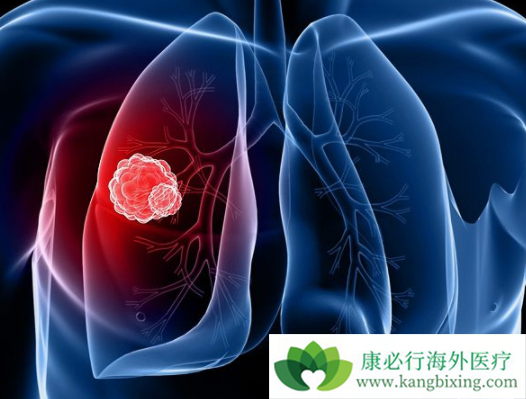 晚期肺癌 晚期肺癌