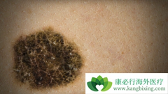 ʲô�Ǻ�ɫ���������ں�ɫ������֢״��������Щ��