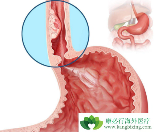 安罗替尼 安罗替尼