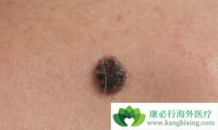 ��ɫ���������ת�Ƶ�֢״����Щ����ת�Ƹ��ʴ󲻴�