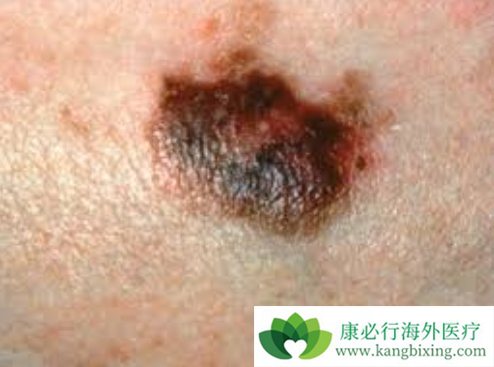 黑色素瘤 黑色素瘤