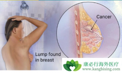 �������ٰ�����HER2�������ٰ�������