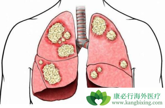 非小细胞肺癌 非小细胞肺癌
