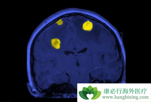 白质脑病 白质脑病