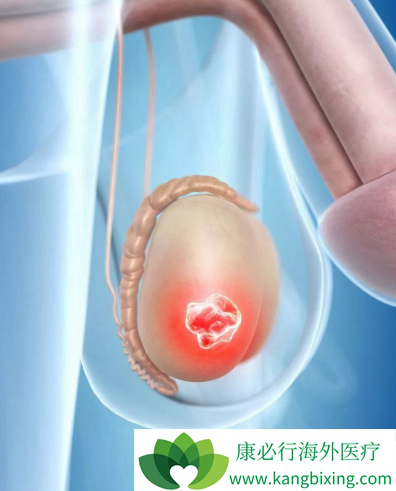 睾丸肿瘤 睾丸肿瘤