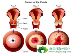 ��ΣHPV�͵�ΣHPV���໥�����ܹ����͹����۰��ķ���