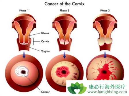 宫颈鳞癌 宫颈鳞癌