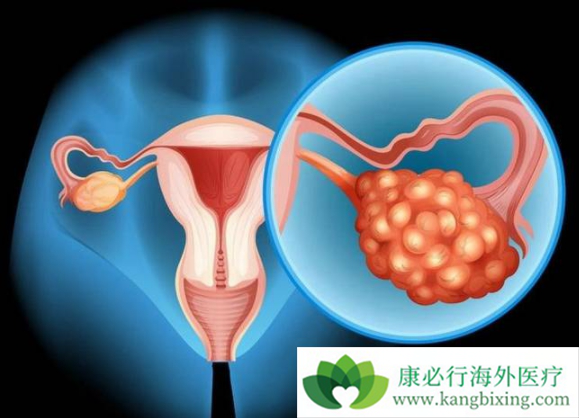 卵巢癌的治疗 卵巢癌的治疗