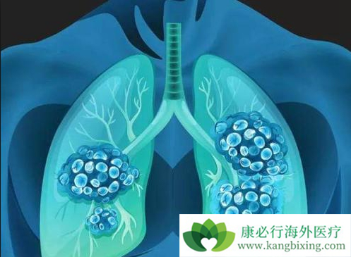 转移性肺癌 转移性肺癌