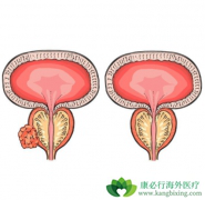 ʲô��ǰ���ٰ���ת�ƣ�ǰ���ٰ�֢��ת�ƺ�������