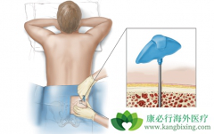 ��Ѫ��������ֲ�ɹ��ʶ��٣��б�Ҫ��ֲ��