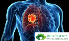 �������ϻ������Ʒΰ������ô��𣿷ΰ�����ʱ�ɼ���PD-1������