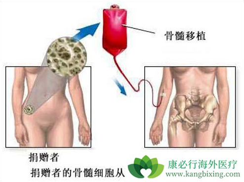 白血病骨髓移植 白血病骨髓移植