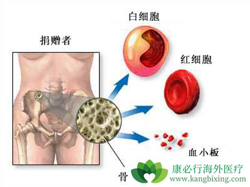 白血病骨髓移植 白血病骨髓移植