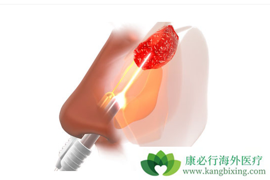 鼻咽癌治疗 鼻咽癌治疗