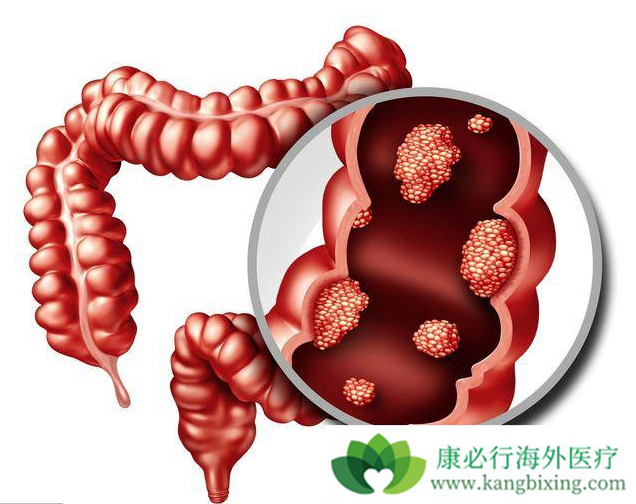 大肠癌早期都有哪些症状表现?