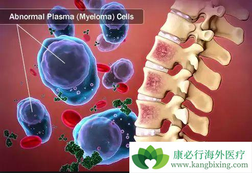 多发性骨髓瘤 多发性骨髓瘤