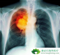 ���ڷΰ����߳�EGFR-TKI����������ָζ��Ե�ԭ����ʲô��