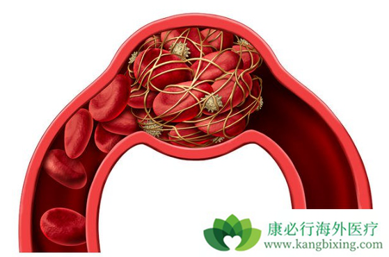 白血病的早期症状 白血病的早期症状