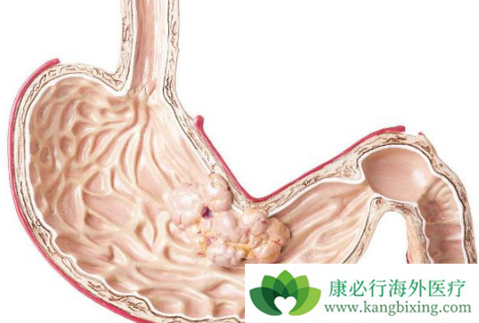 胃癌能活多久 胃癌能活多久