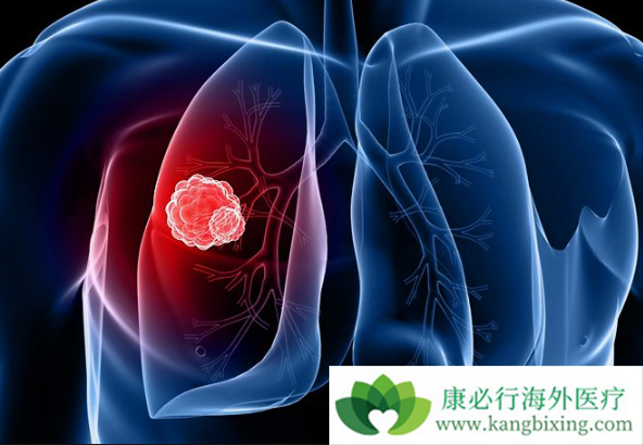 晚期肺癌 晚期肺癌