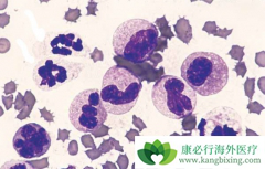 Venetoclax���������������쳣�ۺ�֢���ƴ�����ϣ��