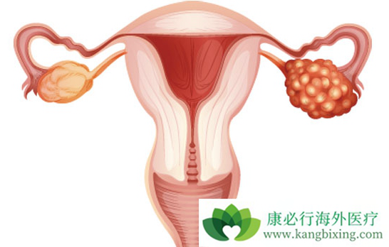 卵巢癌的治疗 卵巢癌的治疗