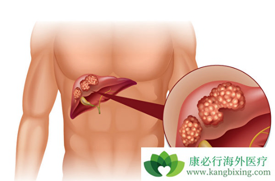 肝癌治疗 肝癌治疗