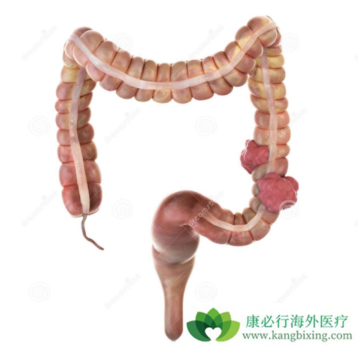 结肠癌治疗 结肠癌治疗